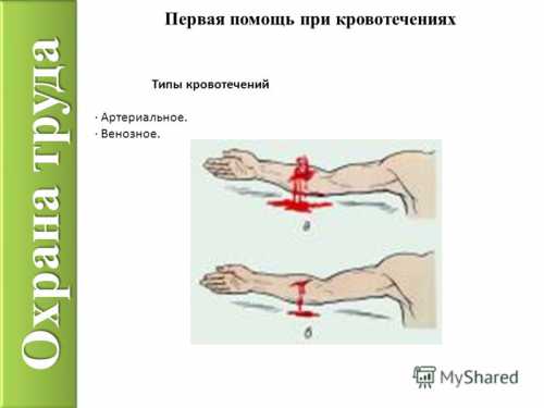 Первая помощь при обширных кровотечениях