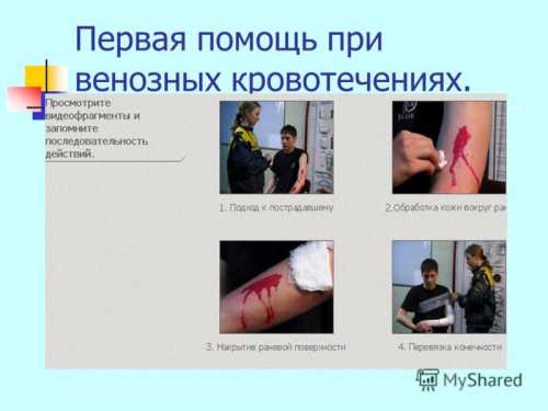 Летом жгут накладываетсяна час, зимой на минут