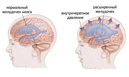 Внутричерепное давление