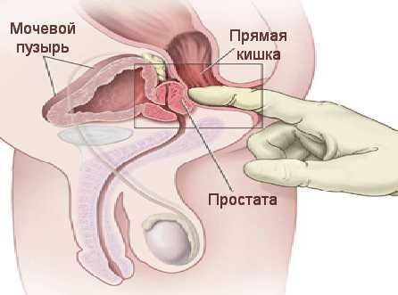 Проведение массажа предстательной железы