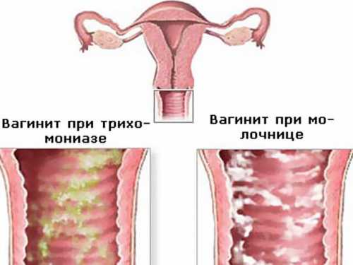 Вагинит: причины, симптомы, лечение