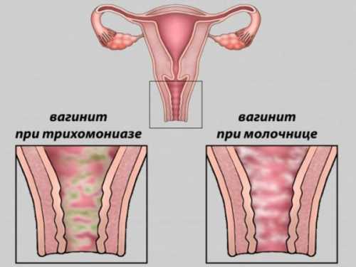У женщины появляются обильные пенистые зловонные выделения беловатого или желтоватого цвета