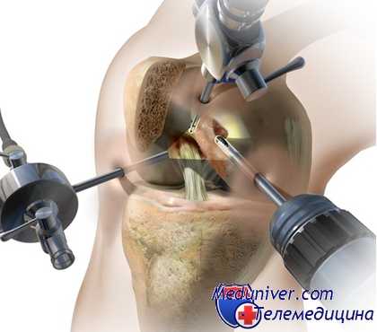 Что такое артроскопия коленного сустава Восстановление после артроскопии