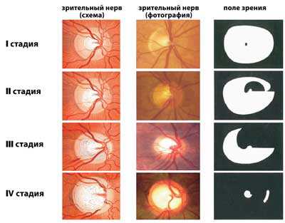 Заболевание зрительного нерва у человека