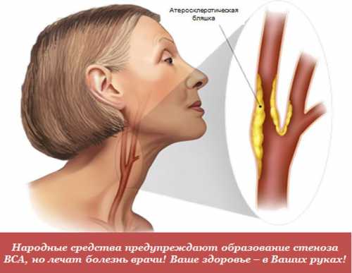 К не медикаментозному лечению, в первую очередь, относится отказ от алкоголя и курения и соблюдение антиатеросклеротиче ской диеты