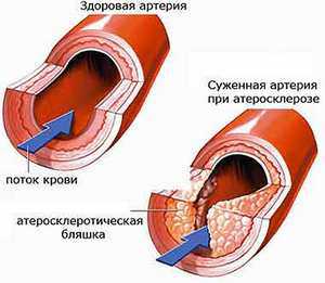 Народные средства от атеросклероза на начальной