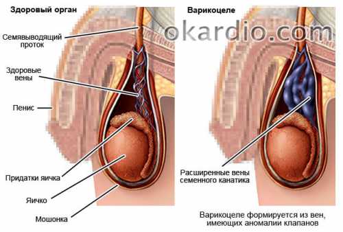 Варикоцеле у мужчин: симптомы, причины, это